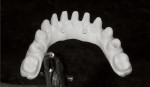 Figure 5  The zirconia framework was milled using CAD/CAM technology.