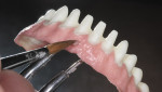 Figure 7  ZirLiner was applied to the gingival areas and enhanced with Berry and Rose e.max gingival stains.