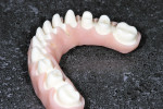 Figure 9  View of the gingival wax-up with crowns removed.