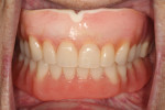 Fig 1. Initial presentation of a patient with an existing maxillary denture and mandibular implant overdenture.