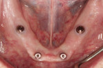 Fig 2. The mandibular edentulous ridge has overdenture abutments (LOCATOR R-Tx, Zest Dental Solutions) in place.