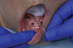 Fig 4. Existing overdenture abutments are removed.