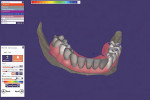 Fig 8. Optical scans are imported into a laboratory software (exocad, exocad GmbH) and prosthetic teeth and base are designed.