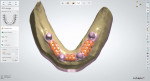 Fig 11. Retention framework is designed on an optical scan of the edentulous ridge with housings using laboratory software (Dental System, 3Shape).
