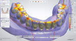 Fig 14. After a copy of the framework design file is made, the prosthetic teeth and base are designed over the framework.