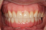 Fig 25. The patient was pleased with the final esthetic and functional result.