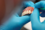 Fig 3. Adding characterization to a denture.