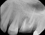 Initial periapical radiograph of fractured tooth No. 14. Note the intimate involvement with the sinus.
