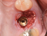 Close-up occlusal view of implant immediately placed into the site No. 14 extraction socket.