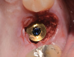 Placement of perio-prosthetic platform designed to seal off the implant-abutment connection on the day of surgery utilizing a surface coating that aids in tissue adherence.