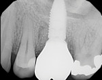 Follow-up, 1-year periapical radiograph of the final screw-retained restoration in place at site No. 14.