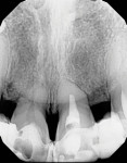 Initial periapical radiograph of teeth Nos. 8 and 9 exhibiting short roots and cantilever restorations.