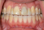 Pretreatment retracted buccal view of teeth Nos. 8 and 9 with cantilever restorations in place revealing poor esthetics.