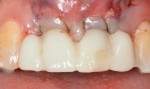 Close-up view of the screw-retained provisional restoration. Note the restored screw access hole on the buccal surface of tooth No. 9.
