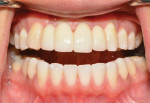 Retacted buccal view of the final screw-retained restoration with the teeth apart. Note the lack of any hint of a screw access hole on the buccal aspect of tooth No. 9. This was achieved using angulated screw channel technology.