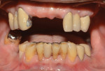 Pretreatment clinical presentation of the dentition prior to maxillary reconstruction.