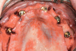 Five multi-unit abutments in place in the maxillary arch. Note the even distribution of implants.