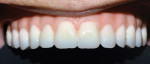 Posttreatment retracted buccal view of the final monolithic zirconia hybrid prosthesis in place. Note the pleasing esthetics provided by the monolithic zirconia.