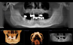Initial CBCT scan of the dentition revealing the presence of only four remaining maxillary teeth.