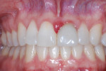Treatment retracted clinical view with teeth in maximum intercuspation.