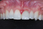 Pretreatment retracted maxillary facial view demonstrating compromised soft tissue biotype and marginal inflammation.