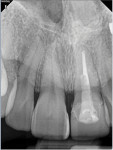 Pretreatment digital periapical radiograph of the endodontically failed maxillary left central incisor.