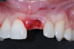 Retracted maxillary facial view following atraumatic removal of the maxillary left central incisor. Note that the soft-tissue contours were preserved.