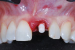 Retracted maxillary facial view following minimally invasive placement of a one-piece tapered 4.0 mm x 12 mm zirconia implant (Z5m(t), Z Systems USA Inc.) to an initial torque index of 50 Ncm