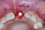 Graft complex placed buccal to the implant fixture using a minimally invasive light condensation protocol.