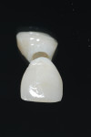 Contoured provisional restoration made by retrofitting the preexisting all-ceramic restoration. Marginal integrity of the provisional was completed extraorally utilizing an implant/abutment replica.