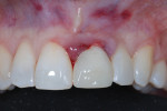 Immediate postoperative clinical view of the provisional restoration seated with temporary cement (ETC™ Easy Temporary Cement, Parkell, Inc.).