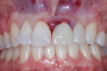 Immediate postoperative retracted view with teeth in maximum intercuspation.