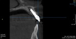 Immediate postoperative CBCT scan cross sectional view of the implant-retained provisional restoration.