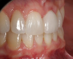 Postoperative retracted close-up right lateral view of the final implant-retained crown exhibiting natural facial gingival tissues and profile.