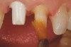 Figure 11  Preoperative photograph of a case in which the patient refused surgery and orthodontics. The treatment goal was to do minimal preparation and use a tough material due to the general medium-to-high risk in every area; obtaining a seal was possible