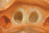 Figure 12  Postoperative photograph with bonded full-contour restorations in place on the posterior teeth and incisally layered anterior teeth.