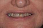 Fig 1 and Fig 2. The patient’s maxillary anterior teeth at presentation. A low lip line was noted upon a wide smile.