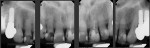 Fig 3. Periapical x-rays of maxillary anterior teeth at presentation. Failing restorative dentistry was noted with blunted root apices from previous adult orthodontics. Prior posterior implants had been placed by the periodontist (RAL) in the past for teeth that were nonrestorable due to caries.