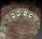 Fig 6. Palatal view of virtual CBCT planning for sites Nos. 7 through 10. Note prosthetically good position along the palatal walls for final screw-retained restorations.