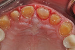 Fig 9. Post-tooth preparation by restorative dentist.