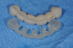 Fig 11. Provisional restoration was duplicated to create an anatomically correct surgical guide with palatal cutout to allow for palatal wall placement in all sockets.