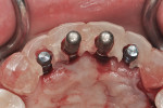 Fig 12. Palatal view of surgical guide in place with final implant placement for sites Nos. 7 and 10 (3.3-mm diameter implants) and 3.5-mm indicators in place for 4.1-mm diameter implants for sites Nos. 8 and 9.