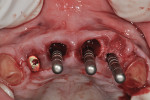 Fig 13. Sites Nos. 8 and 9 with 3.5-mm diameter indicators in place with buccal gaps measured >2 mm.