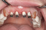 Fig 17. Titanium temporary cylinders in place and shaded tooth color (Nos. 7 through 10).