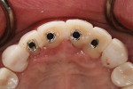 Fig 19. Provisionals were brought into the mouth and luted to the titanium temporary abutments with flowable composite.