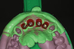 Fig 25. Complete maxillary arch open-tray impression with polyvinyl siloxane impression material with custom impression copings imbedded.