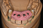 Fig 26. Master model showing the subgingival depth of the palatally placed implants and the duplicated transitional zone that was copied by the custom impression coping technique