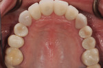 Fig 29. Completed maxillary case in situ. Nos. 4, 5, and 12 are previously treated single-tooth implants placed by RAL.