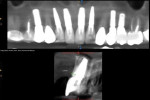 Fig 32. CBCT slice No. 9 at 2.5 years post-implant placement (September 26, 2019); 2.2 mm buccal wall was present.