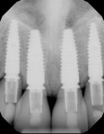 Fig 33. Periapical radiograph at 3.5 years post-implant placement (July 2020). Interproximal heights of bone were maintained with the use of the slow-resorbing biomaterial that was packed to the bony wall heights of the individual sockets at the time of implant placement.